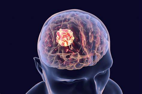 Brain Cancer Markers: Unlocking the Mysteries of Early Diagnosis and Treatment