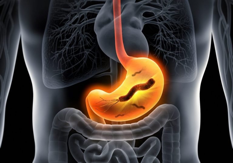 Understanding Helicobacter pylori: Diagnostics, Clinical Significance & Complications