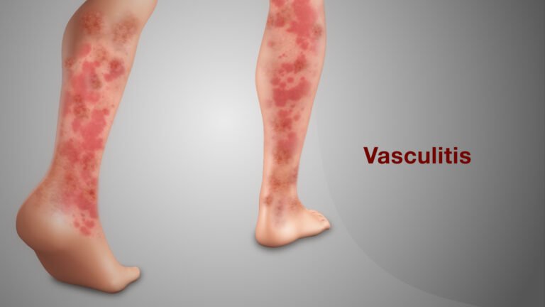 Understanding Vasculitis: Clinical Significance and Diagnosis Using HOB Line Immunoassay Kits